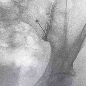 Infiltración sacroilíaca guiada por RX