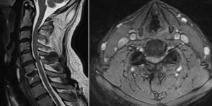 Resonancia Columna Cervical Sindrome nivel adyacente