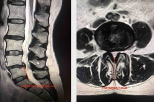 Espondilolistesis L4-L5 con estenosis del canal central Espondilolistesis L4-L5 con estenosis del canal central