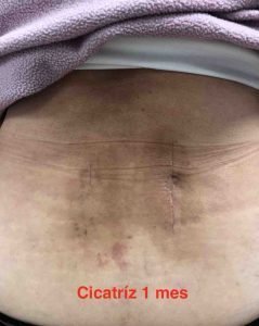 Cicatriz tras un mes de la cirugía Cicatriz tras un mes de la cirugía