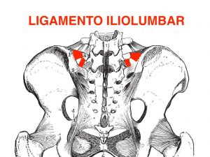 "Ilustración anatómica enfocando el ligamento iliolumbar destacado en rojo dentro de la estructura de la pelvis, útil para entender problemas lumbares."