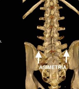 Asimetría apófisis transversas L5 sindrome iliolumbar