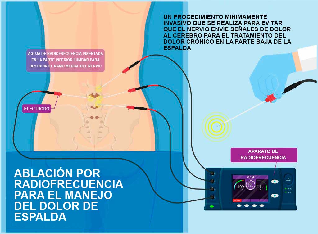 Ilustración detallada de la rizolisis en la zona lumbar, mostrando agujas de radiofrecuencia apuntando a los nervios específicos para aliviar el dolor de espalda