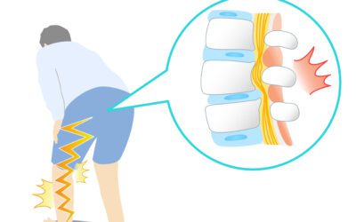 Estenosis de canal lumbar: síntomas, causas y tratamiento