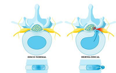 Hernia discal: Síntomas, causas y tratamientos
