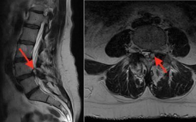 QUISTE FACETARIO SINOVIAL LUMBAR: Síntomas, Tratamientos y Cirugía Endoscópica