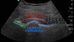 Imagen del procedimiento de infiltración ecoguiada en la cadera