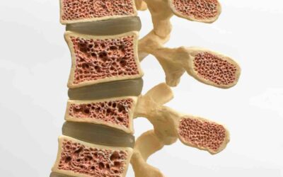 FRACTURA VERTEBRAL OSTEOPORÓTICA