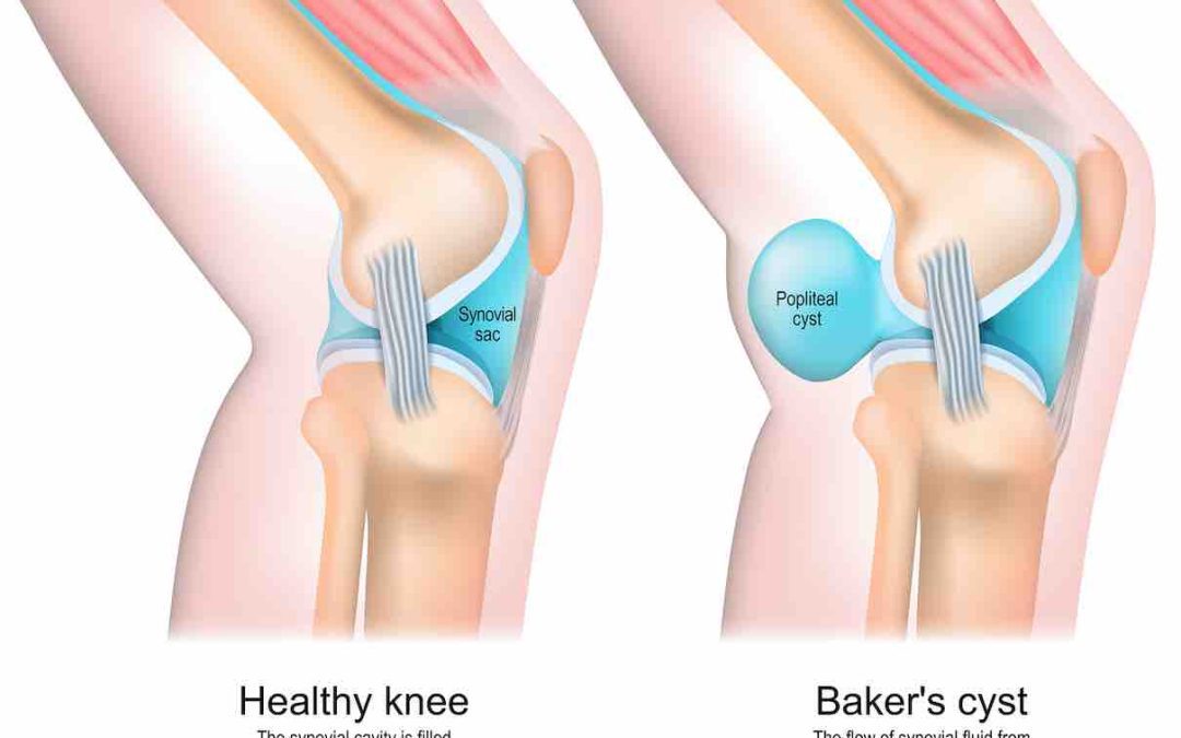 Quiste de Baker: Síntomas, causas y tratamientos del quiste poplíteo