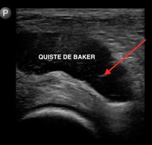 quiste de baker ecografia