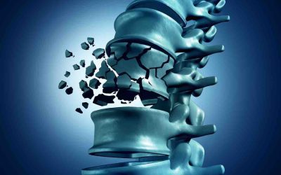Fractura vertebral: Causas, síntomas y tratamientos
