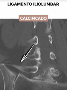 "Imagen de T.A.C. mostrando calcificación en el ligamento iliolumbar, evidenciando síndrome iliolumbar"