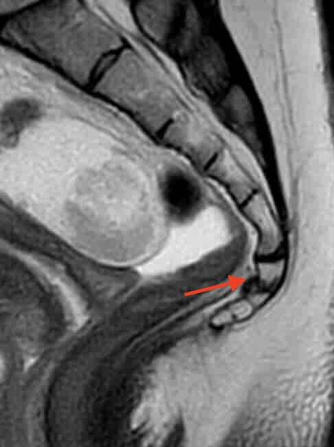 Imagen de resonancia magnética de la columna inferior donde una flecha roja indica la presencia de una fractura en el cóccix