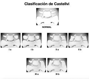 Clasificación de Castellvi de las anomalías de transición lumbosacra con imágenes de los diferentes tipos.