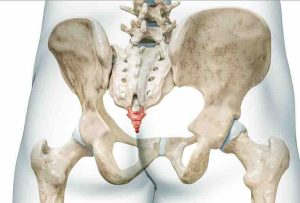 Coccigodinia. Qué es, síntomas y tratamiento. Ilustración de la zona de la cadera con el coxis inflamado