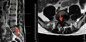 magen de resonancia magnética con flechas rojas que señala una hernia masiva y severa a nivel L5-S1, casi ocupando completamente el canal medular.