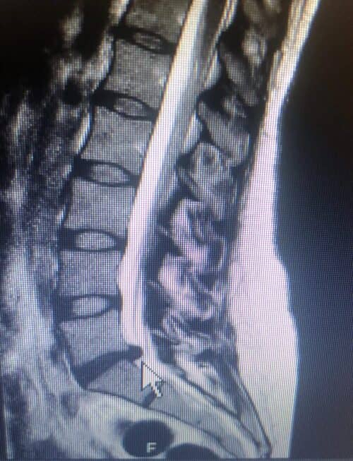 Corte sagital de resonancia magnética de la columna lumbar con hernia discal en L5-S1