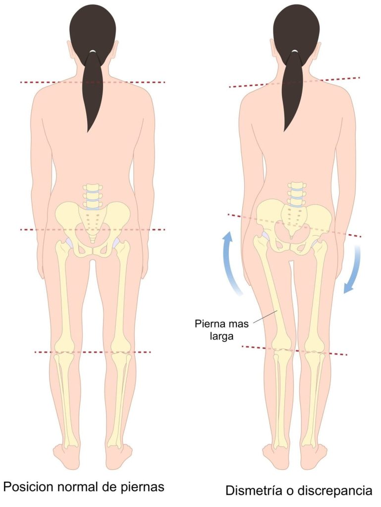 Dismetría de miembros inferiores