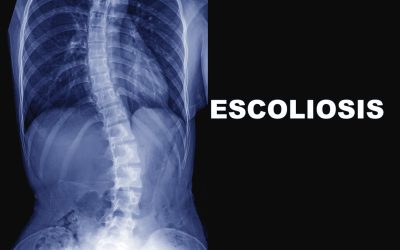 Escoliosis: síntomas, diagnóstico y tratamiento