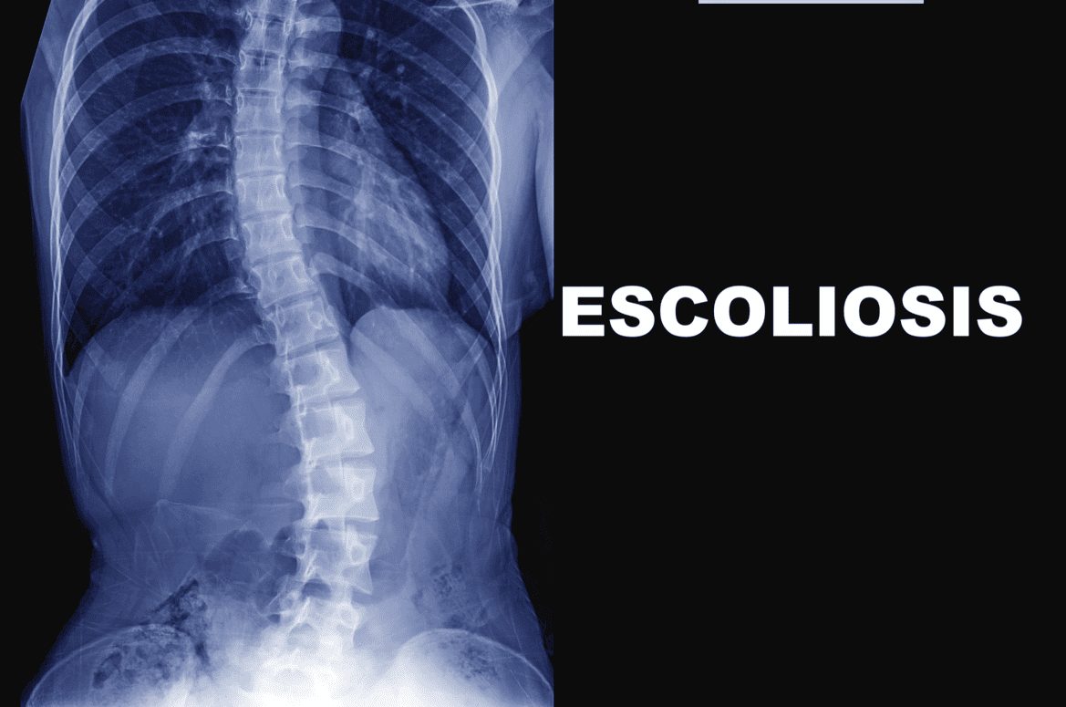 Escoliosis: Causas y Tratamiento para la escoliosis