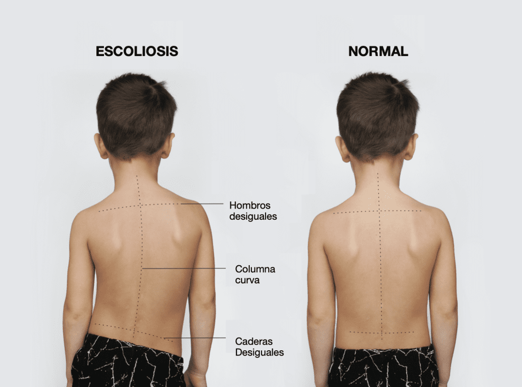 Comparación de las espaldas de un niño con escoliosis y un niño normal, mostrando hombros y caderas desiguales y una columna vertebral curva.