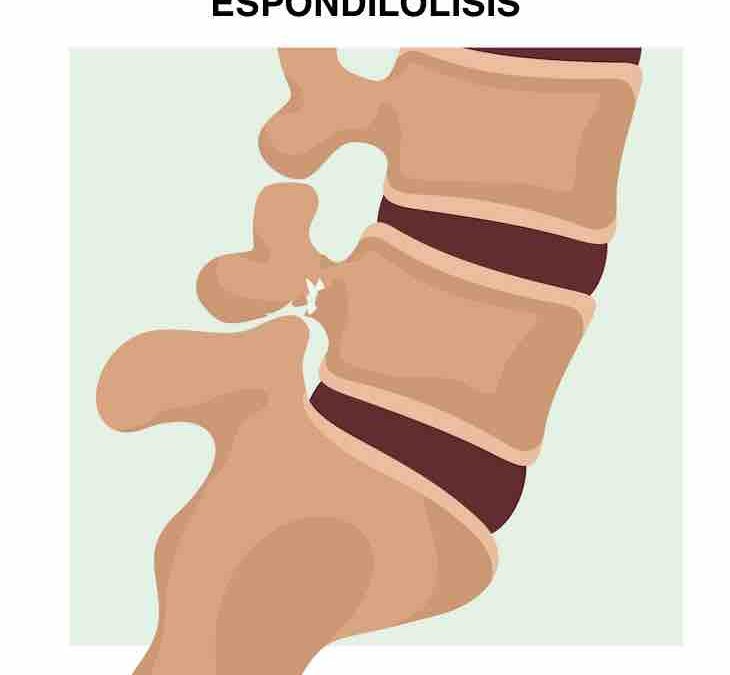 Espondilolisis: una visión detallada de esta afección de la columna vertebral