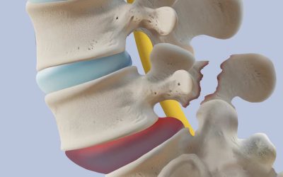 Espondilolistesis: Causas, Síntomas y Tratamientos Efectivos