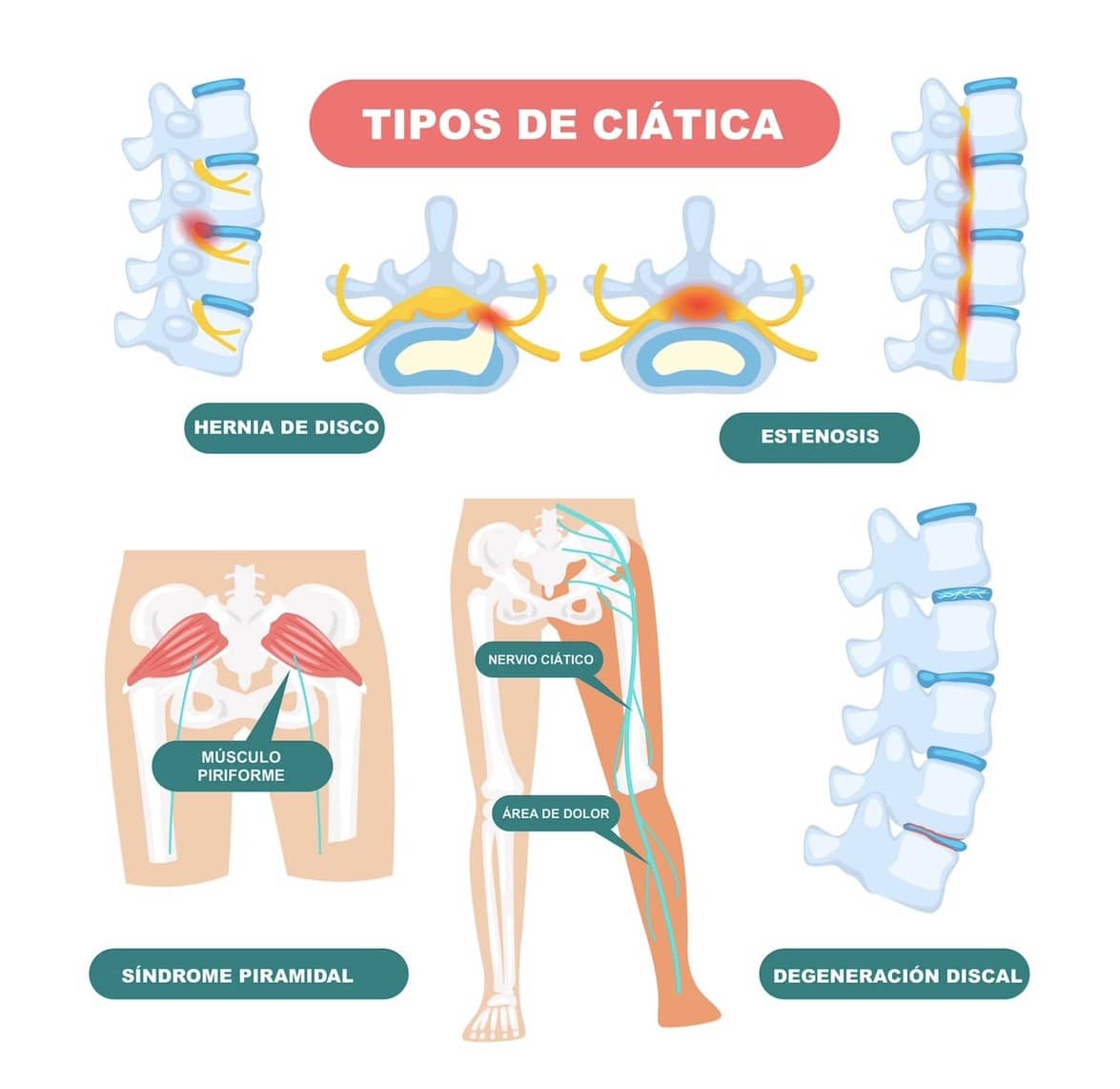 Diagrama ilustrativo que muestra los tipos de ciática, incluyendo hernia de disco, estenosis de canal, síndrome piramidal y degeneración discal.