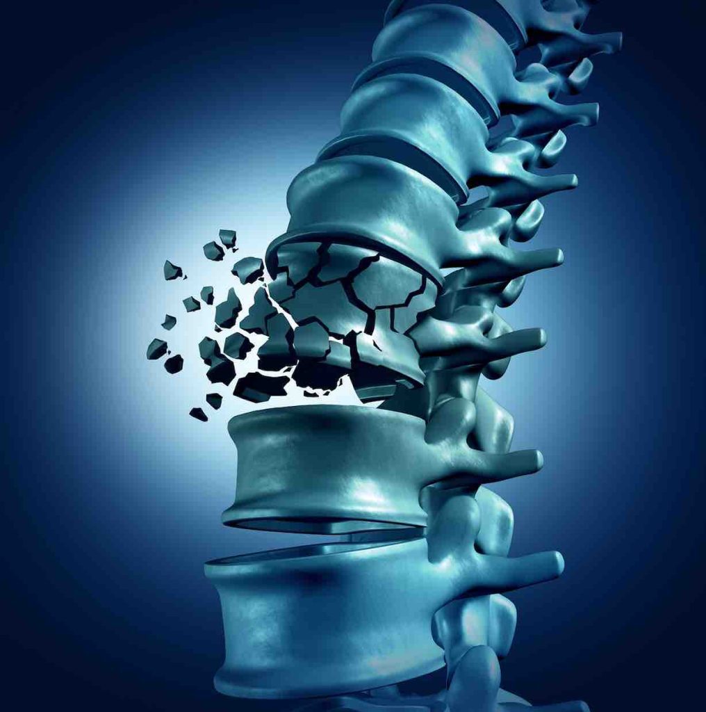 Ilustración de una columna vertebral humana con una fractura en una de las vértebras, destacando la zona dañada y la necesidad de atención médica especializada