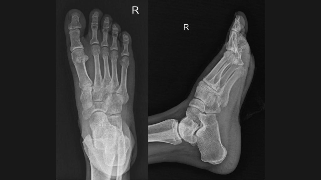 Radiografía de la fascitis plantar