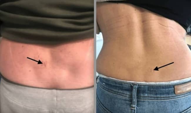 Imagen de dos pacientes con cicatriz de cirugía endoscópica de columna no invasiva