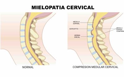 Mielopatía cervical: causas, síntomas y tratamiento