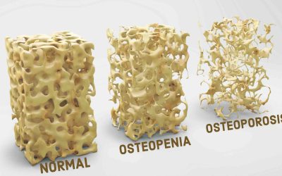 OSTEOPOROSIS: Causas, Síntomas y Tratamiento