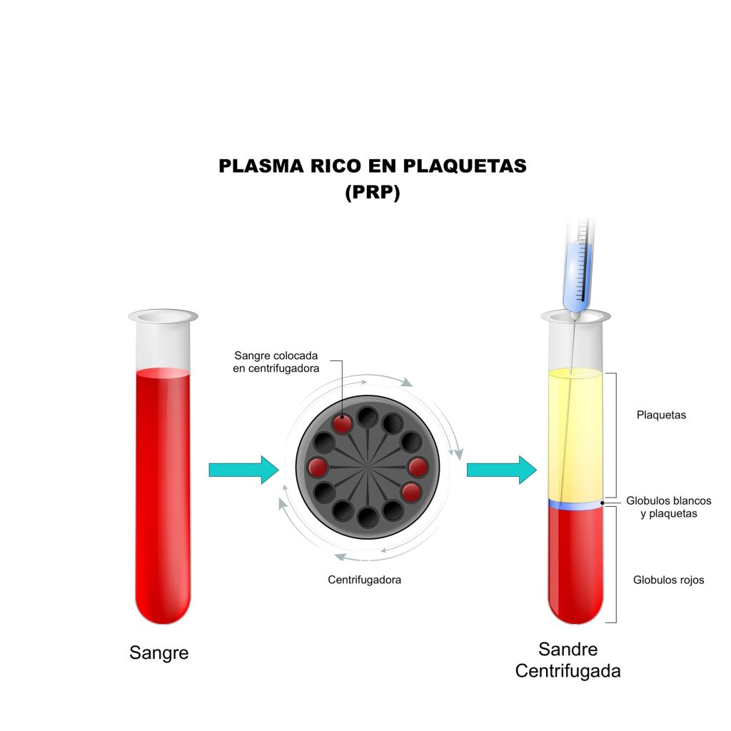 PRP ESQUEMA