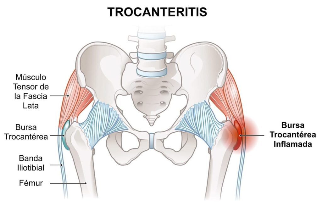 Qué es la Trocanteritis y mejor tratamiento