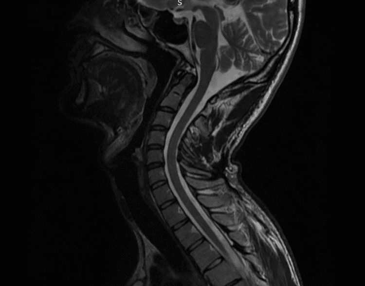 Resonancia magnética en corte sagital de columna cervical mostrando hiperlordosis cervical.