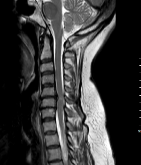 Imagen sagital en T2 de resonancia magnética ilustrando hernia discal C5-6 con mielopatía.
