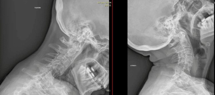 RX dinámicas columna cervical