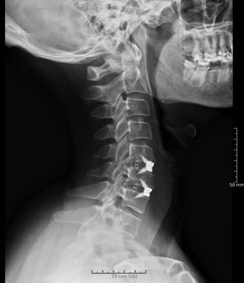 Imagen de radiografía cervical lateral que ilustra artrodesis con cajas intersomáticas en C5-6 y C6-7