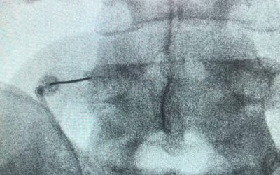 Rizolisis por radiofrecuencia: Tratamiento eficaz para el dolor crónico de espalda