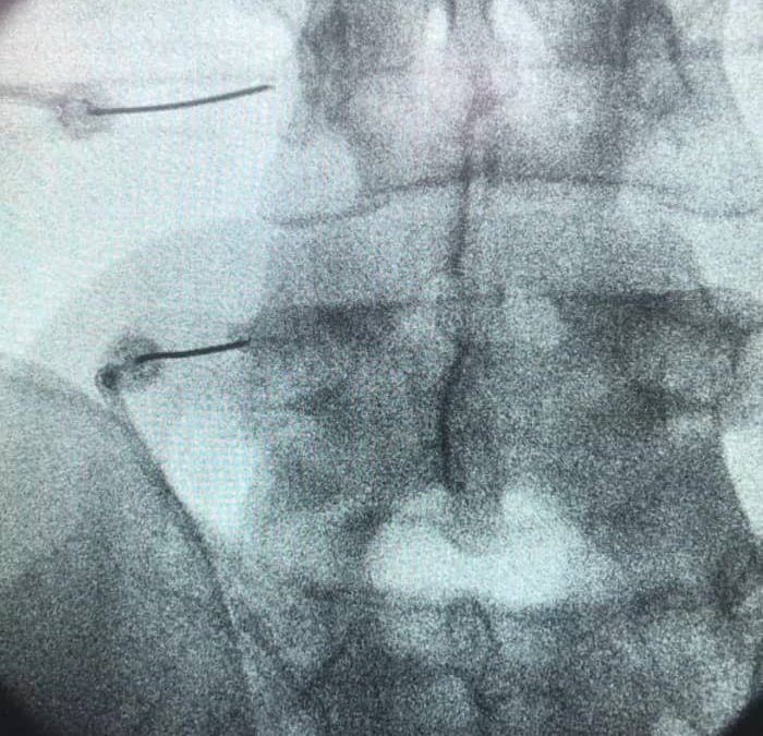 Rizolisis por radiofrecuencia: Tratamiento eficaz para el dolor crónico de espalda