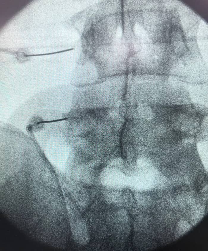Radiografía de columna lumbar mostrando el procedimiento de rizolisis con agujas de radiofrecuencia en acción, un método innovador para el alivio del dolor de espalda