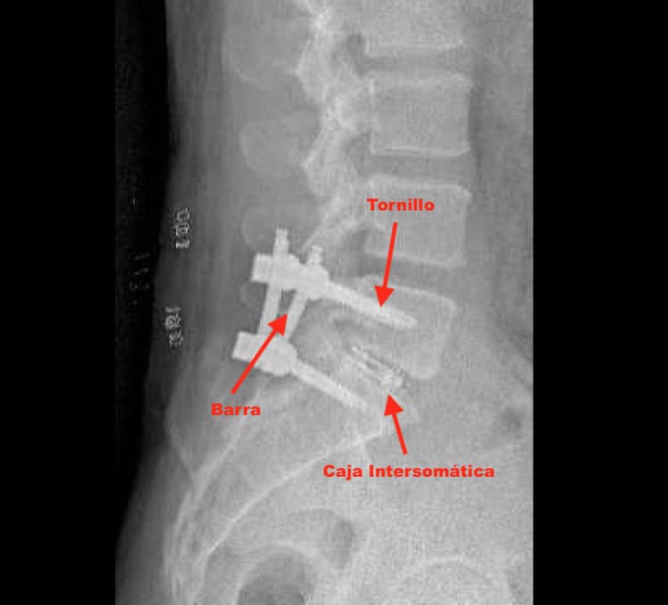 Radiografía lateral de una artrodesis L5-S1 por endoscopia con señalamientos en flechas rojas de la caja intersomática, los tornillos y la barra.