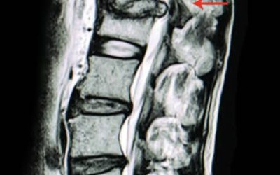 Espondilodiscitis: Definición, Diagnóstico y Tratamiento Completo