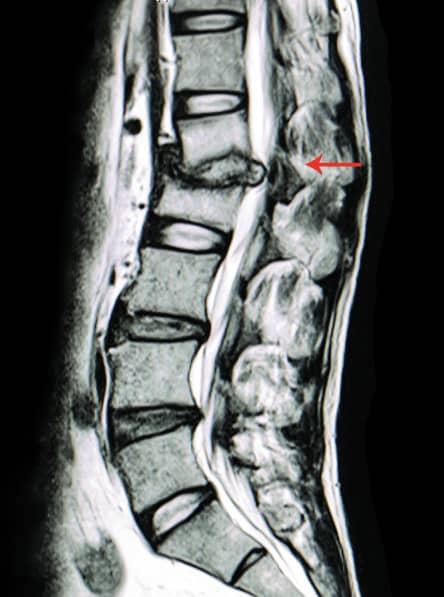 Espondilodiscitis: Definición, Diagnóstico y Tratamiento Completo