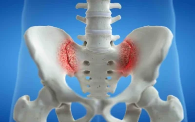 SACROILITIS o SACROILEITIS: Dolor o inflamación de la articulación sacroiliaca