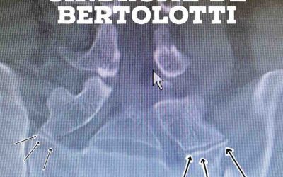 Síndrome de Bertolotti: Causas, síntomas y tratamiento eficaz