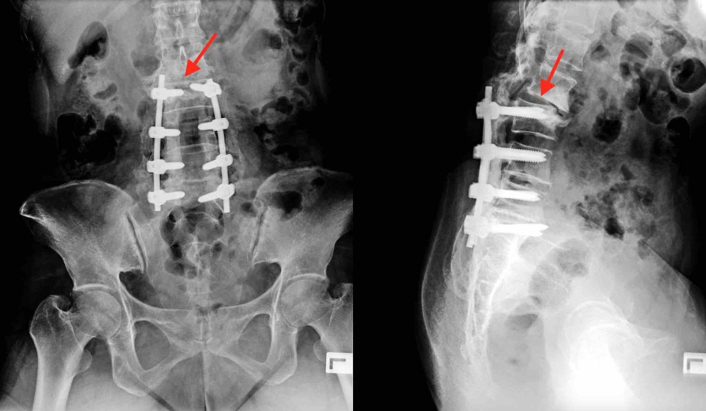 Imagen de radiografía que ilustra el síndrome del Segmento Adyacente (SSA) o Síndrome de nivel Adyacente (SNA) en la columna vertebral
