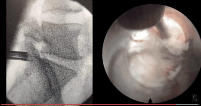 Vídeo sobre una discectomía endoscópica de columna lumbar, con el control radiológico de la cirugía en la izquierda y la raíz nerviosa liberada sin hernia en la derecha