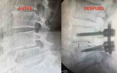 Artrodesis lumbar percutánea